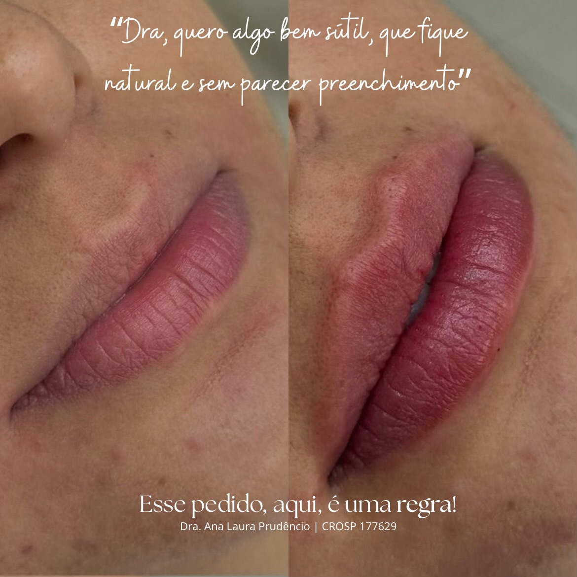 Antes e depois de preenchimento labial sutil