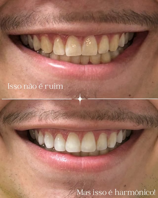 Antes e depois de harmonização do sorriso, com clareamento dental